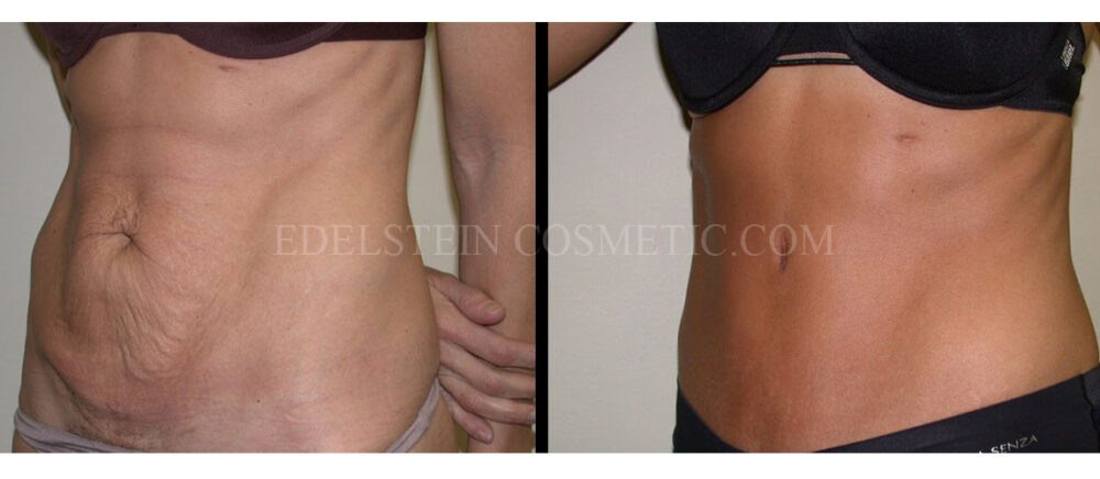 Tummy Tuck case #26611