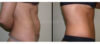 Tummy Tuck case #26611 slider thumbnail