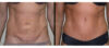 Tummy Tuck case #26611 slider thumbnail