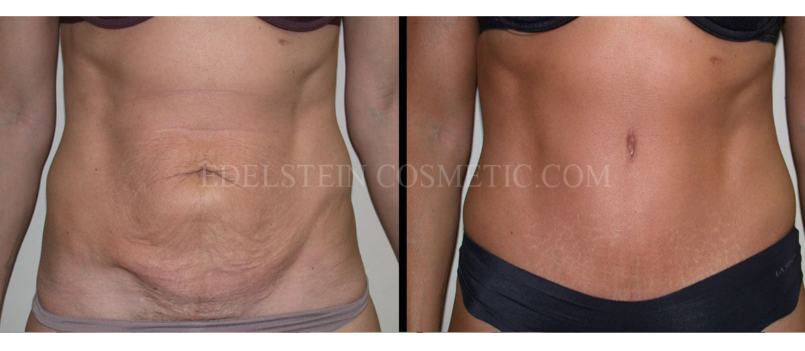 Tummy Tuck case #26611