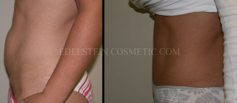 Tummy Tuck case #26610