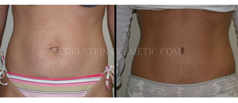 Tummy Tuck case #26610