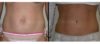 Tummy Tuck case #26610 slider thumbnail