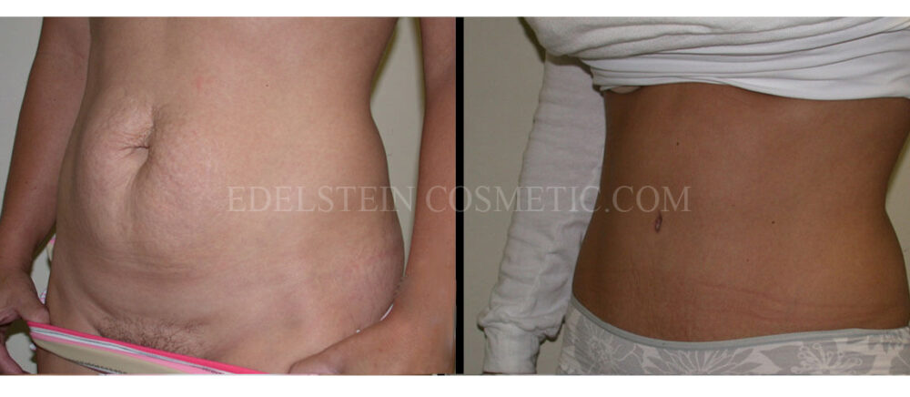 Tummy Tuck case #26610