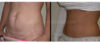 Tummy Tuck case #26610 slider thumbnail