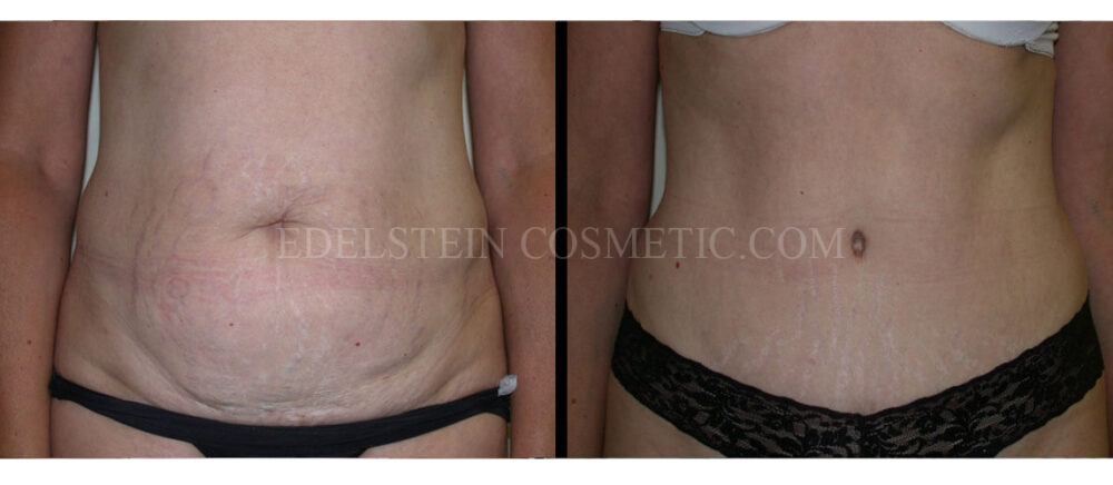 Tummy Tuck case #26609