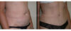 Tummy Tuck case #26609 slider thumbnail