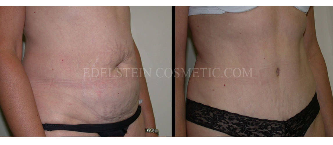 Tummy Tuck case #26609