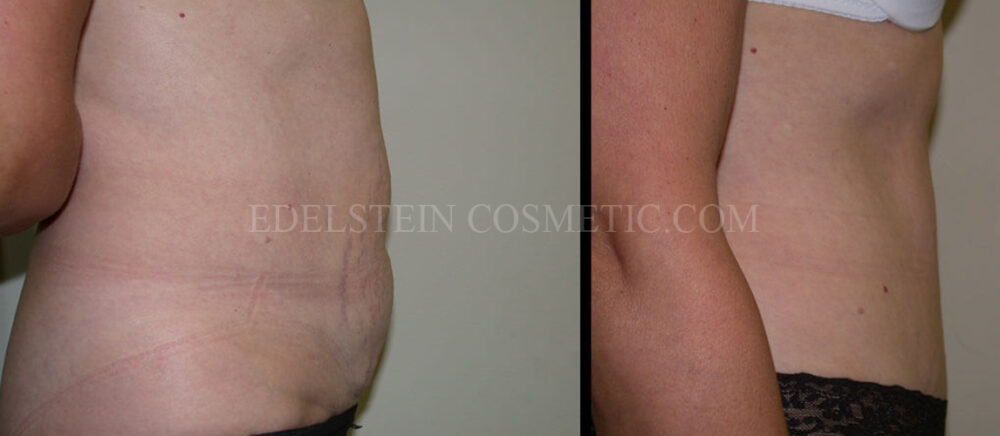 Tummy Tuck case #26609