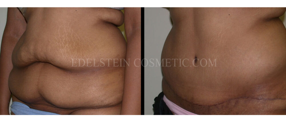 Tummy Tuck case #26608