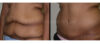 Tummy Tuck case #26608 slider thumbnail