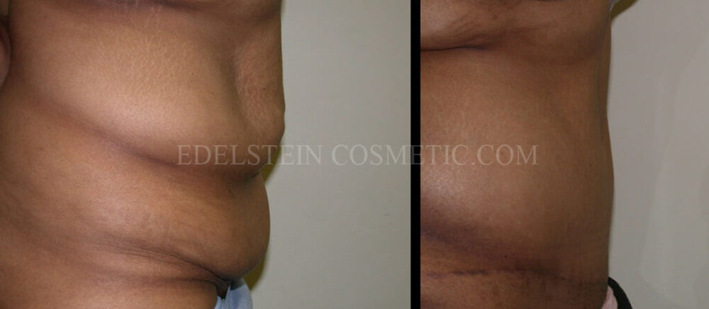 Tummy Tuck case #26608