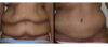 Tummy Tuck case #26608 slider thumbnail