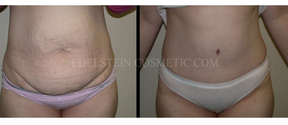 Tummy Tuck case #26607