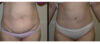 Tummy Tuck case #26607 slider thumbnail