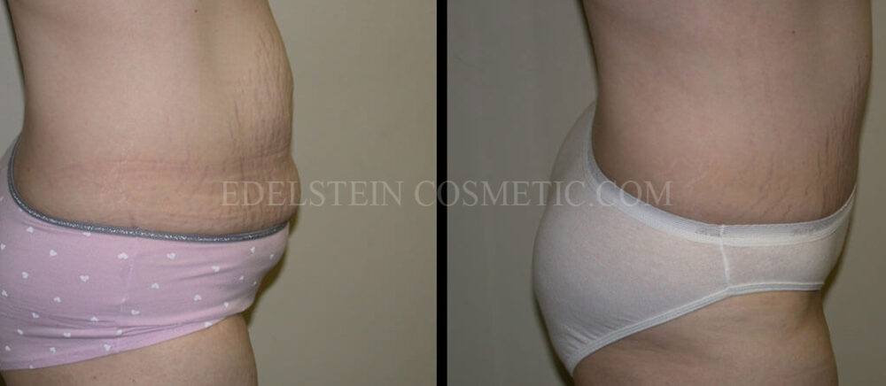 Tummy Tuck case #26607