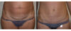 Tummy Tuck case #26606 slider thumbnail