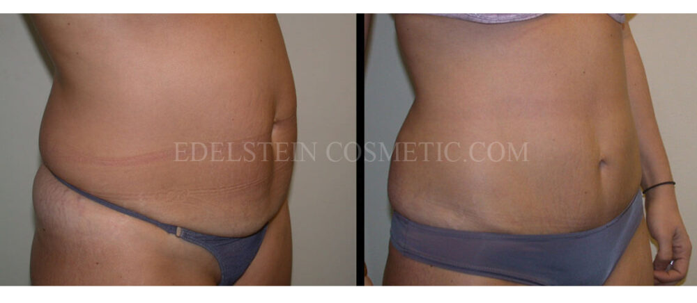 Tummy Tuck case #26606