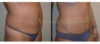 Tummy Tuck case #26606 slider thumbnail