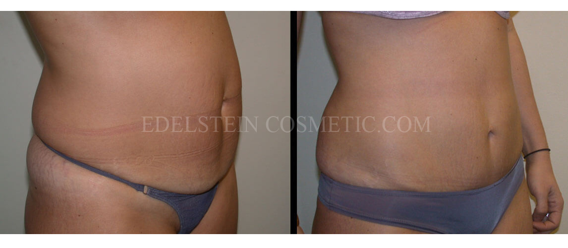 Tummy Tuck case #26606