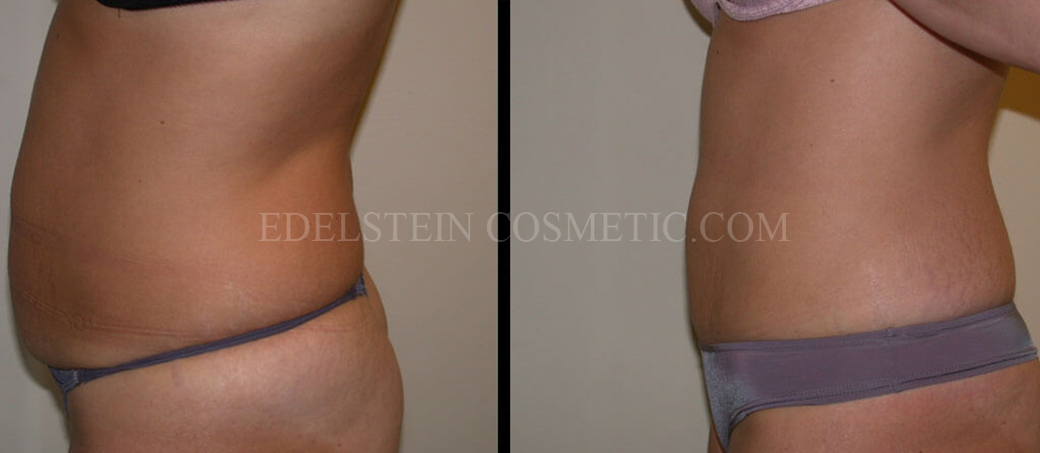 Tummy Tuck case #26606