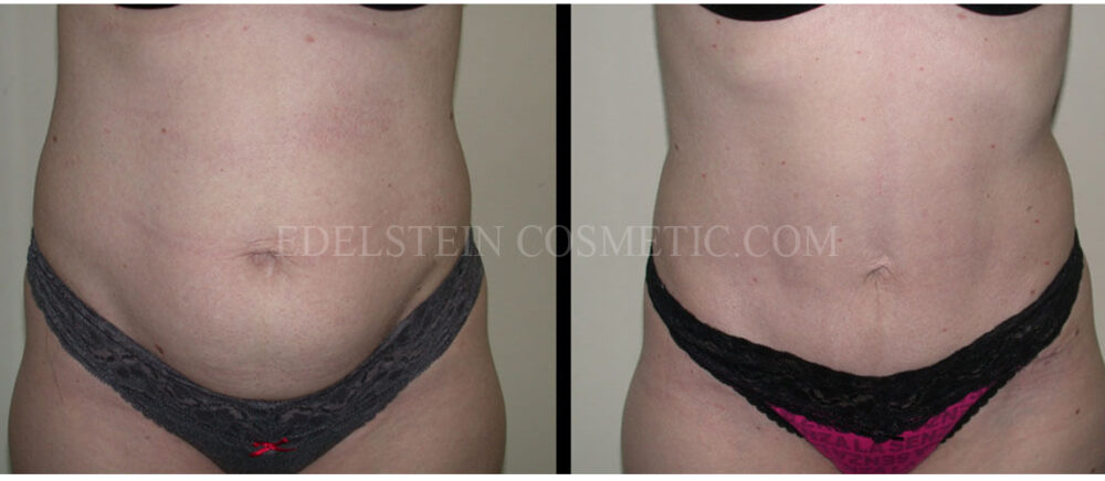 Tummy Tuck case #26605