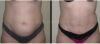 Tummy Tuck case #26605 slider thumbnail