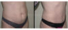 Tummy Tuck case #26605 slider thumbnail