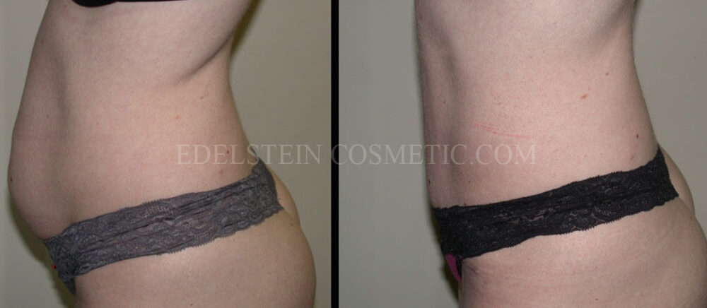 Tummy Tuck case #26605