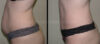 Tummy Tuck case #26605 slider thumbnail