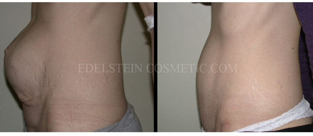 Tummy Tuck case #26604