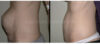 Tummy Tuck case #26604 slider thumbnail