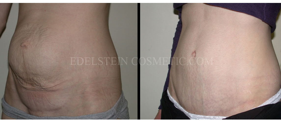 Tummy Tuck case #26604