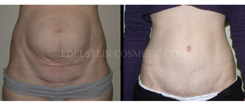 Tummy Tuck case #26604