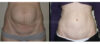 Tummy Tuck case #26604 slider thumbnail