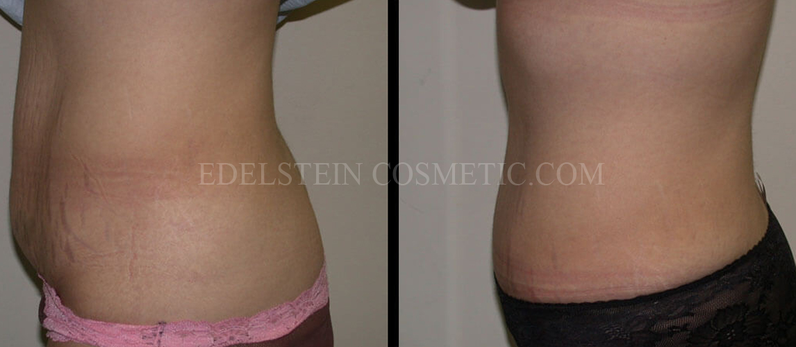 tummy-tuck-toronto-before-after-p36