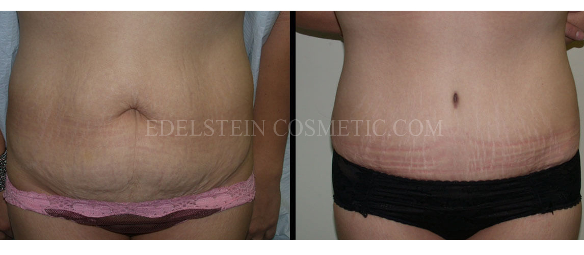 tummy-tuck-toronto-before-after-p36a