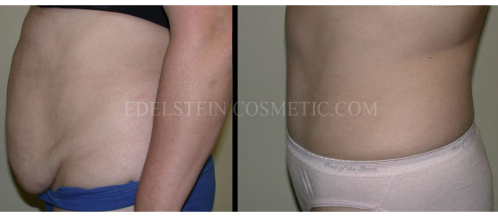 Tummy Tuck case #26602