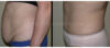 Tummy Tuck case #26602 slider thumbnail