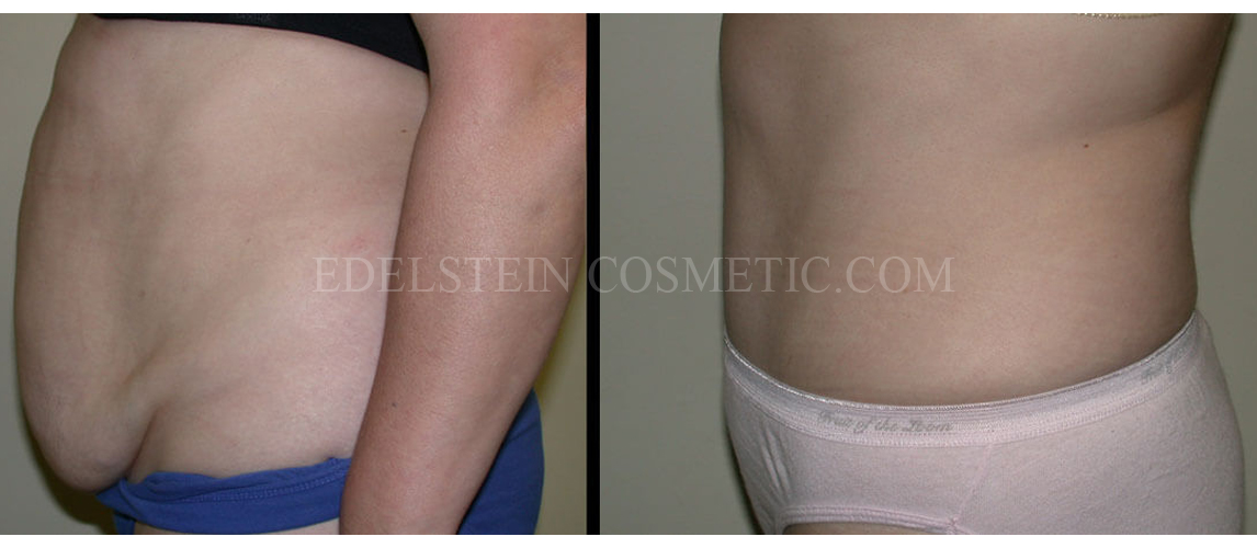 Tummy Tuck case #26602