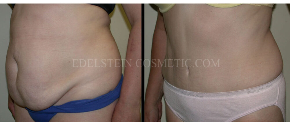 Tummy Tuck case #26602