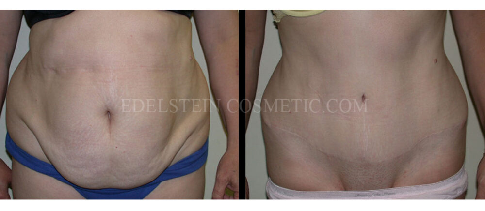 Tummy Tuck case #26602