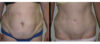 Tummy Tuck case #26602 slider thumbnail