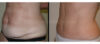 Tummy Tuck case #26601 slider thumbnail