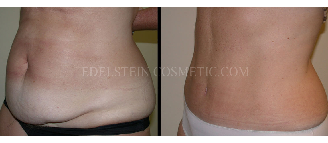 Tummy Tuck case #26601