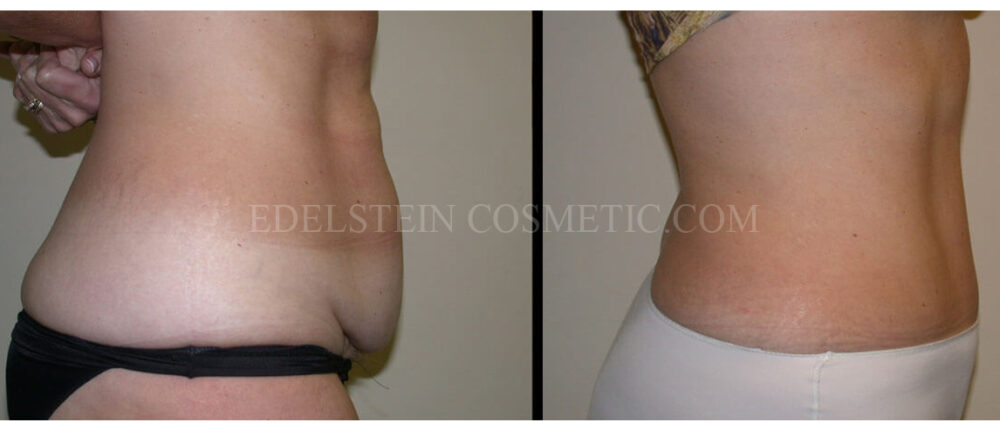 Tummy Tuck case #26601