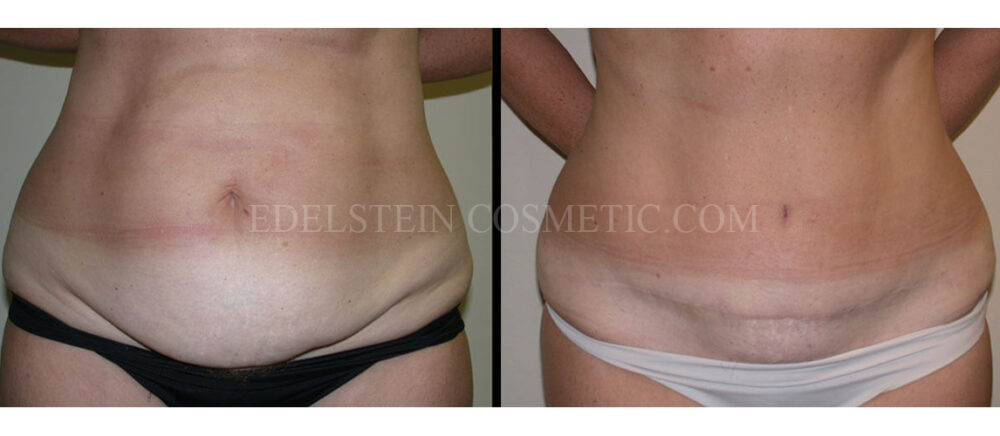 Tummy Tuck case #26601