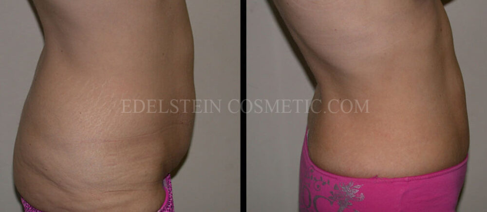 Tummy Tuck case #26600