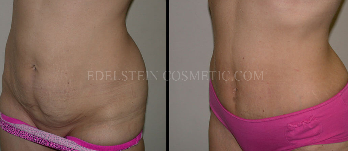 Tummy Tuck case #26600