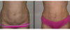 Tummy Tuck case #26600 slider thumbnail